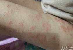 孕期湿疹怎么治疗（孕期湿疹怎么治疗最快）