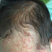 单纯疱疹怀孕16周宝宝胎停是这个病毒影响的吗,疱疹对胎儿有什么影响吗