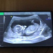 12周胎儿头臀径标准,怀孕12周胎儿会动吗正常吗