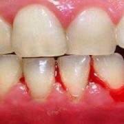 怀孕牙龈出血正常吗,怀孕期间牙龈出血怎么回事儿