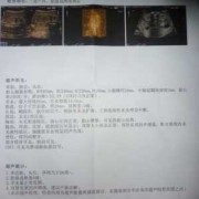 胎儿双肾实质回声增强（胎儿双肾实质回声增强）
