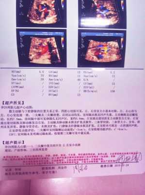 胎儿心脏彩超(胎儿心脏彩超多少周做最佳时间) 第3张 胎儿心脏彩超(胎儿心脏彩超多少周做最佳时间) 第3张