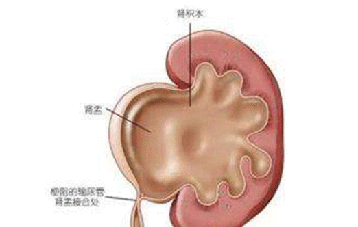 胎儿肾盂分离（胎儿肾盂分离是什么意思）  第2张