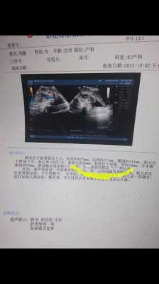 胎儿颈部可见u型压迹什么意思（胎儿颈部可见u型切迹是啥意思）  第3张