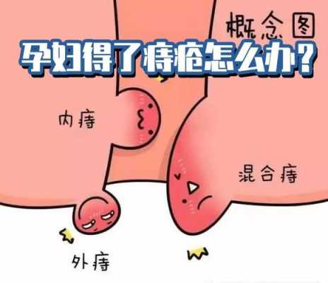 孕妇长痔疮应该怎么治疗啊,孕期痔疮出肉球怎么办 第3张 孕妇长痔疮应该怎么治疗啊,孕期痔疮出肉球怎么办 第3张