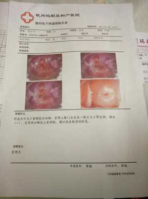 宫颈短卧床休息能长长吗,孕期宫颈短怎么长上去 20周 第2张 宫颈短卧床休息能长长吗,孕期宫颈短怎么长上去 20周 第2张