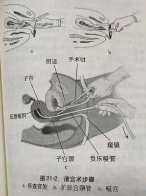 如何打掉胎儿(如何打掉胎儿危害小) 第2张 如何打掉胎儿(如何打掉胎儿危害小) 第2张