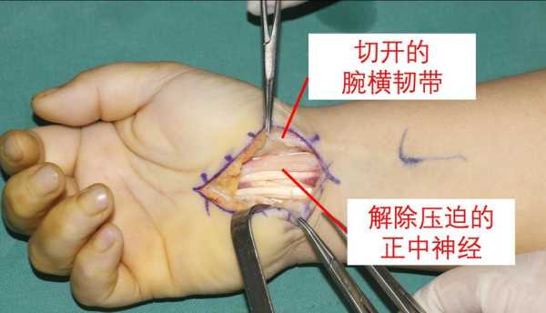 孕妇32周手麻，手疼，手肿。是怎么回事,孕期腕管综合征产后多久恢复正常  第1张