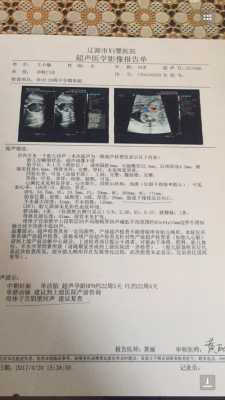 单脐动脉对胎儿有什么影响（胎儿单脐动脉会有什么影响）  第3张
