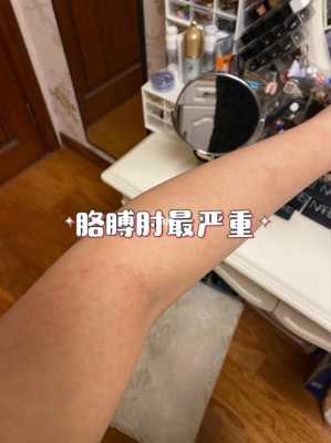 孕期湿疹（孕期湿疹止痒最有效的方法）  第2张