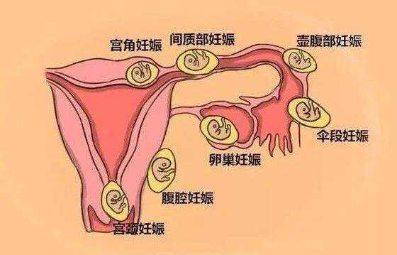 孕期有褐色分泌物怎么回事,孕早期有褐色分泌物是怎么回事 第3张 孕期有褐色分泌物怎么回事,孕早期有褐色分泌物是怎么回事 第3张