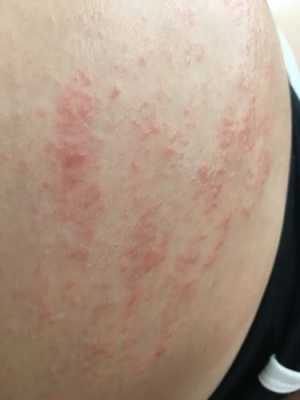 孕期肚皮痒怎么回事(孕期肚皮痒怎么回事长红颗粒) 第3张 孕期肚皮痒怎么回事(孕期肚皮痒怎么回事长红颗粒) 第3张