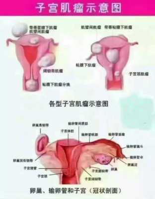 孕期子宫肌瘤(孕期子宫肌瘤可以顺产吗) 第2张 孕期子宫肌瘤(孕期子宫肌瘤可以顺产吗) 第2张