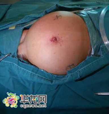 我老婆怀孕6个月查出左肾积水是怎么回事,胎儿肾积水是什么原因引起的 第2张 我老婆怀孕6个月查出左肾积水是怎么回事,胎儿肾积水是什么原因引起的 第2张