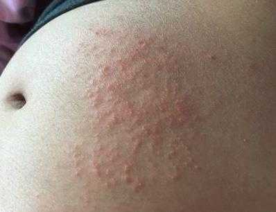 孕妇为什么会得湿疹,孕期湿疹止痒最有效的方法 第2张 孕妇为什么会得湿疹,孕期湿疹止痒最有效的方法 第2张