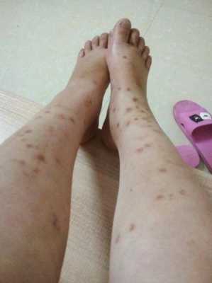 孕妇为什么会得湿疹,孕期湿疹止痒最有效的方法 第3张 孕妇为什么会得湿疹,孕期湿疹止痒最有效的方法 第3张