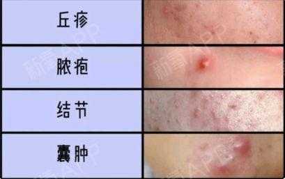 怀孕脸上长痘痘是什么原因,孕期脸上长痘痘是什么原因导致的 第1张 怀孕脸上长痘痘是什么原因,孕期脸上长痘痘是什么原因导致的 第1张