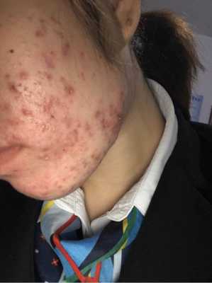 怀孕脸上长痘痘是什么原因,孕期脸上长痘痘是什么原因导致的 第3张 怀孕脸上长痘痘是什么原因,孕期脸上长痘痘是什么原因导致的 第3张