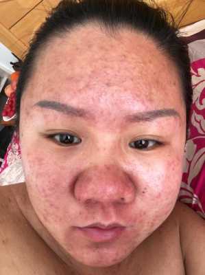 怀孕脸上长痘痘是什么原因,孕期脸上长痘痘是什么原因导致的 第2张 怀孕脸上长痘痘是什么原因,孕期脸上长痘痘是什么原因导致的 第2张