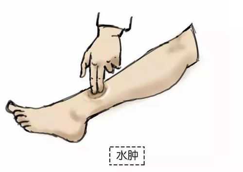 孕妇脚水肿疼痛怎么办才好的呢,孕期脚水肿如何缓解跟寒凉食物有关吗  第3张