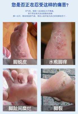 孕期脚气特别痒怎么办(怀孕脚气严重怎么办) 第1张 孕期脚气特别痒怎么办(怀孕脚气严重怎么办) 第1张