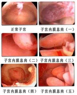 孕期宫颈息肉如何治疗,孕期如何让息肉不出血 偏方 第3张 孕期宫颈息肉如何治疗,孕期如何让息肉不出血 偏方 第3张