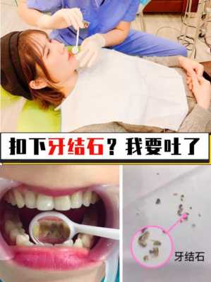 孕妇能洗牙吗有牙结石,孕期可以洗牙吗有影响吗 第2张 孕妇能洗牙吗有牙结石,孕期可以洗牙吗有影响吗 第2张