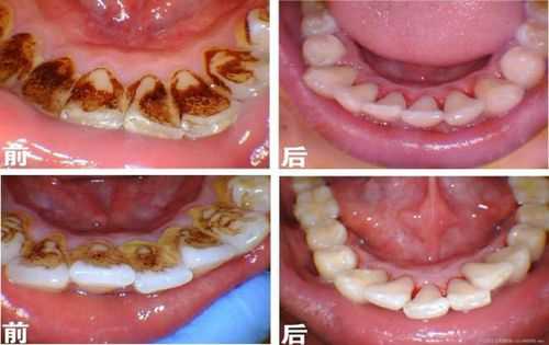 孕妇能洗牙吗有牙结石,孕期可以洗牙吗有影响吗 第1张 孕妇能洗牙吗有牙结石,孕期可以洗牙吗有影响吗 第1张