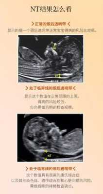 胎儿颈项透明层厚度正常值（胎儿颈项透明层厚度1.3是男孩女孩）  第2张