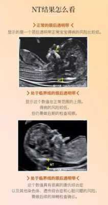 胎儿颈项透明层厚度正常值(胎儿颈项透明层厚度1.3是男孩女孩) 第2张 胎儿颈项透明层厚度正常值(胎儿颈项透明层厚度1.3是男孩女孩) 第2张
