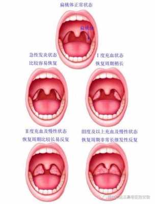 孕妇有炎症对胎儿有影响吗,孕妇扁桃体炎能自愈吗 第1张 孕妇有炎症对胎儿有影响吗,孕妇扁桃体炎能自愈吗 第1张