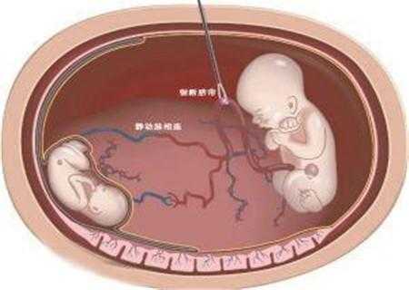 减胎对另一个胎儿有什么影响（减胎对另一个胎儿有什么影响）  第1张