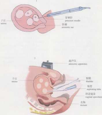 减胎对另一个胎儿有什么影响（减胎对另一个胎儿有什么影响）  第2张