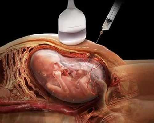 孕妇抽羊水检查对胎儿有危害吗,孕妇做羊水穿刺对胎儿有影响吗  第2张
