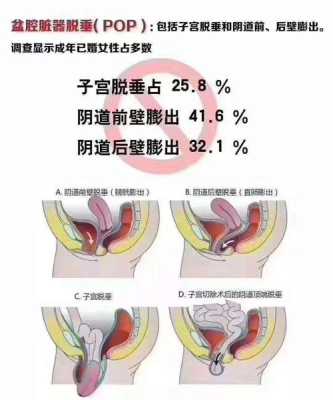 孕期 漏尿(什么是阴吹和漏尿,阴吹的症状表现) 第2张 孕期 漏尿(什么是阴吹和漏尿,阴吹的症状表现) 第2张