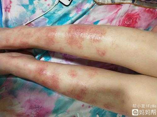 怀孕得了孕期湿疹要怎么办,孕期湿疹图片症状图片 第2张 怀孕得了孕期湿疹要怎么办,孕期湿疹图片症状图片 第2张