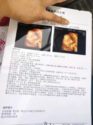 双肾盂未见分离是什么意思,胎儿双侧肾盂无分离是男是女 第3张 双肾盂未见分离是什么意思,胎儿双侧肾盂无分离是男是女 第3张