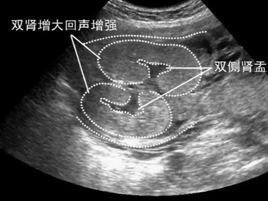 双肾盂未见分离是什么意思,胎儿双侧肾盂无分离是男是女 第2张 双肾盂未见分离是什么意思,胎儿双侧肾盂无分离是男是女 第2张