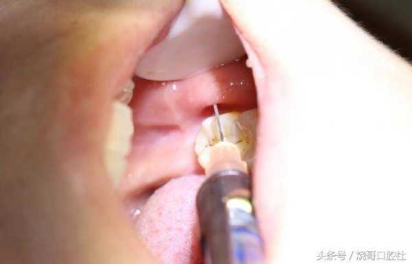 备孕期间可以拔牙吗(男的拔牙能要孩子吗) 第2张 备孕期间可以拔牙吗(男的拔牙能要孩子吗) 第2张