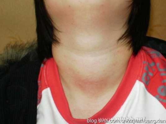 甲亢什么症状,孕期甲亢症状表现有哪些 第2张 甲亢什么症状,孕期甲亢症状表现有哪些 第2张