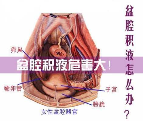 盆腔积液影响胎儿吗(怀孕了有盆腔积液怎么办) 第2张 盆腔积液影响胎儿吗(怀孕了有盆腔积液怎么办) 第2张