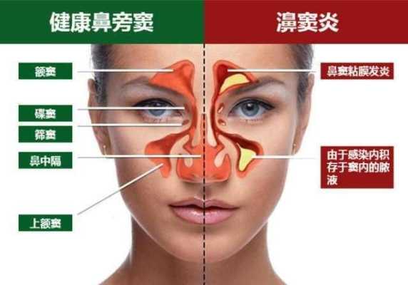 孕期鼻炎犯了怎么办(怀孕期间鼻炎严重怎么办) 第2张 孕期鼻炎犯了怎么办(怀孕期间鼻炎严重怎么办) 第2张