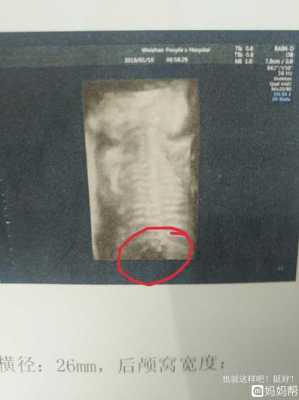 宝宝练习趴着抬头翻过来怎么翻,四维胎儿趴着怎么尽快转身 第2张 宝宝练习趴着抬头翻过来怎么翻,四维胎儿趴着怎么尽快转身 第2张