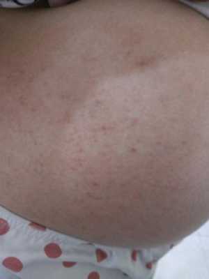 孕期肚皮痒怎么缓解(怀孕32周肚皮痒怎么办?有同样情况的吗) 第2张 孕期肚皮痒怎么缓解(怀孕32周肚皮痒怎么办?有同样情况的吗) 第2张