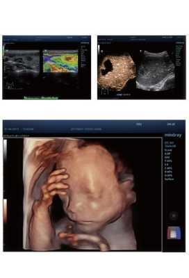 胎儿系统性彩色多普勒超声筛查（胎儿系统性彩色多普勒超声筛查几周做）  第2张