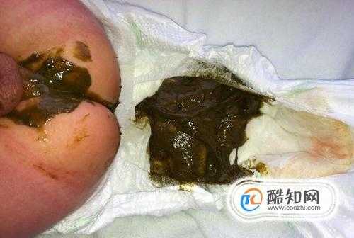 刚出生的婴儿拉了好多胎便,是正常的吗?几天可以排干净,胎儿多少周会出现胎粪呢图片 第2张 刚出生的婴儿拉了好多胎便,是正常的吗?几天可以排干净,胎儿多少周会出现胎粪呢图片 第2张