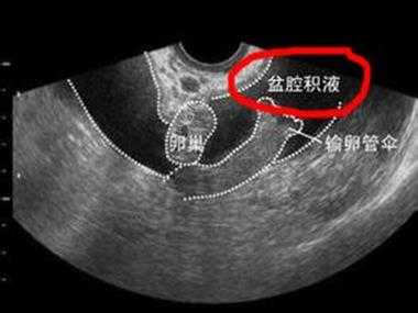 盆腔积液怀孕了对胎儿有影响吗（盆腔积液怀孕了对胎儿有影响吗）  第2张