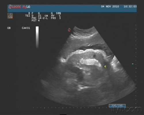 胎儿肠管扩张是什么原因造成的（怀孕28周胎儿腹部肠管回声增强是怎么回事）  第2张