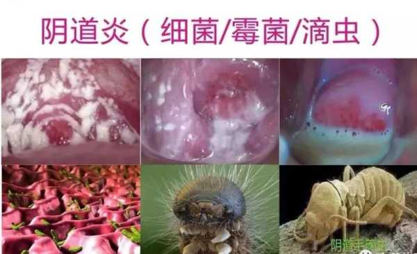 怀孕白带多像豆腐渣怎么办,孕期下面痒有豆腐渣怎么办  第1张