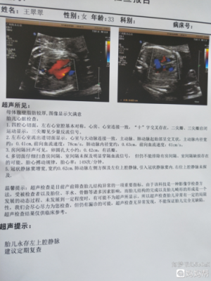 胎儿永存左上腔静脉是什么意思,四维检查胎儿永存左上腔静脉是什么意思 第2张 胎儿永存左上腔静脉是什么意思,四维检查胎儿永存左上腔静脉是什么意思 第2张